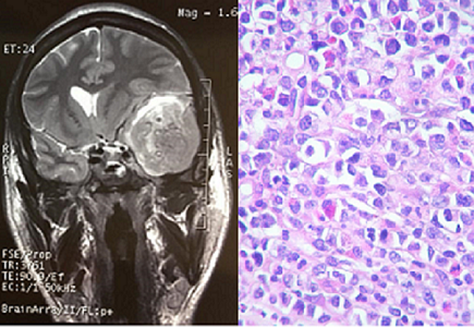 PRIMARY CENTRAL NERVOUS SYSTEM MYELOID SARCOMA EVOLVING FROM A EHA